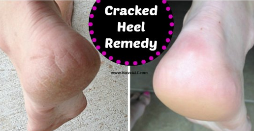 cracked heel home remedy